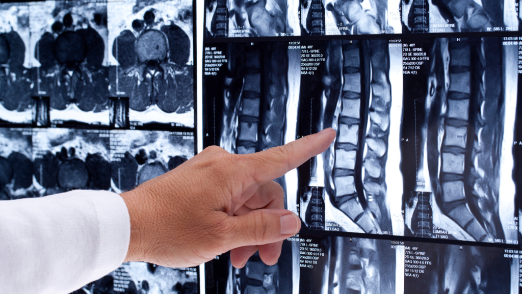 What does an MRI show after a car accident image of spinal scan results being reviewed