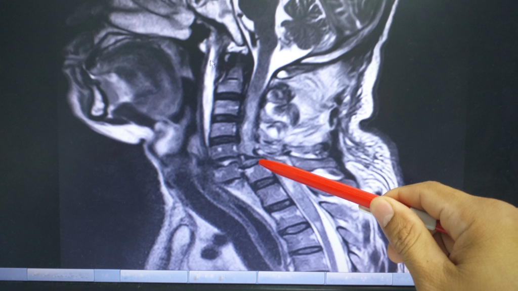 How MRIs Help a Personal Injury Case: Proven Benefits for Your Claim How MRIs help a personal injury case with spinal scan highlighting disc injury